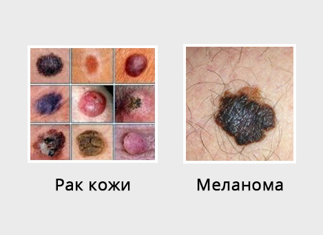Меланома и рак кожи